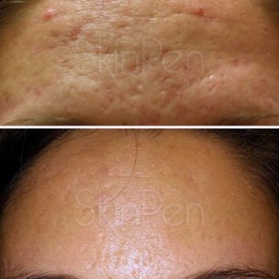SkinPen Microneedling Before and After Innovative Aesthetics Medical Spa and Laser Center