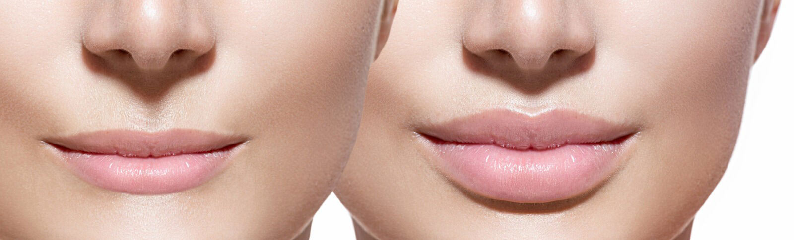 Innovative Aesthetics Medical Spa and Laser Center Filler Slider