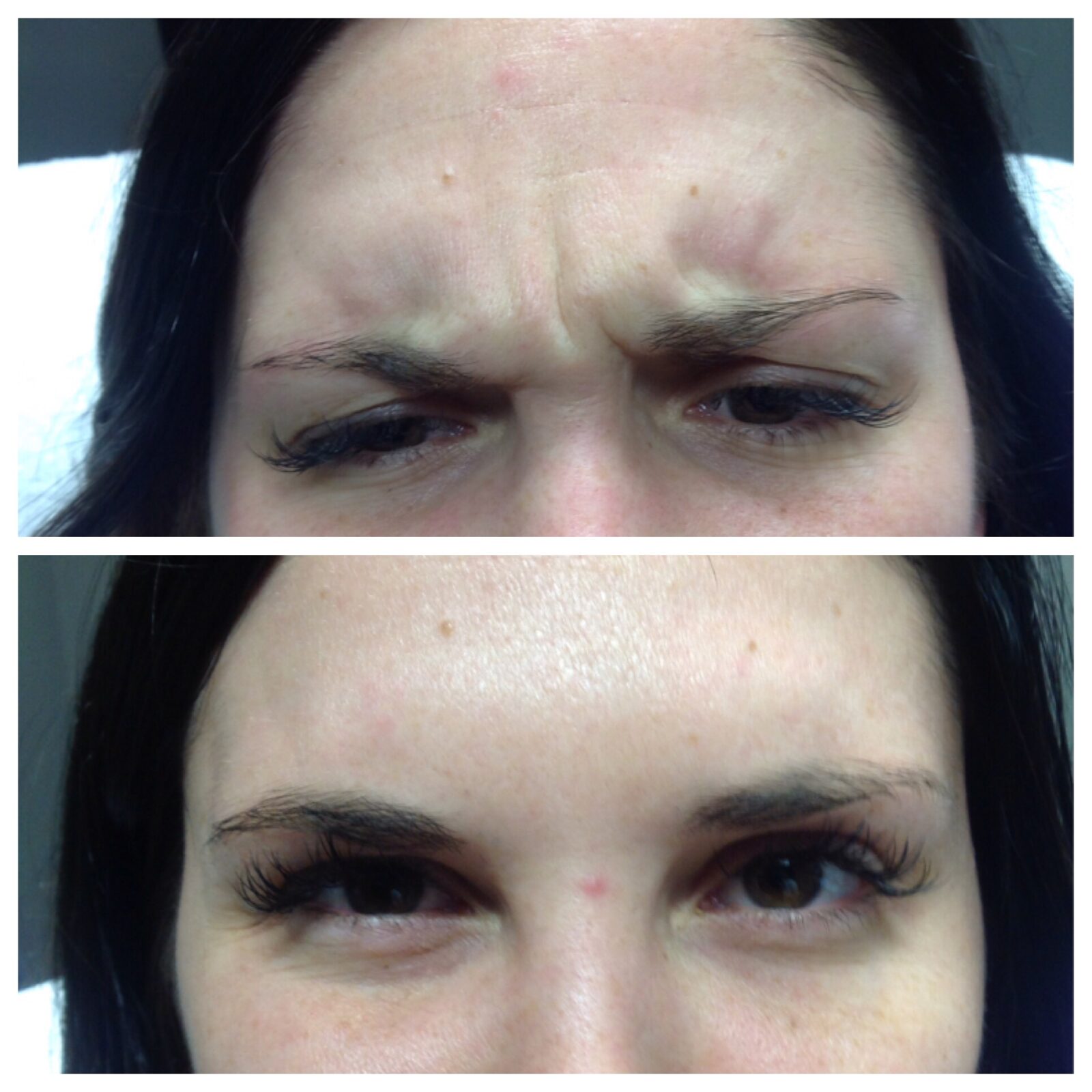 Forehead-Botox-Before-After_Innovative-Aesthetics-Spa-Laser-Center-Cedar-Rapids