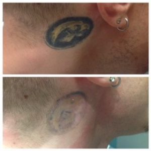 Laser Tattoo Removal | Innovative Aesthetics Spa and Laser Center - Cedar Rapids