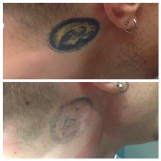 Hawkeye Tattoo Removal Innovative Aesthetics Medical Spa and Laser Center