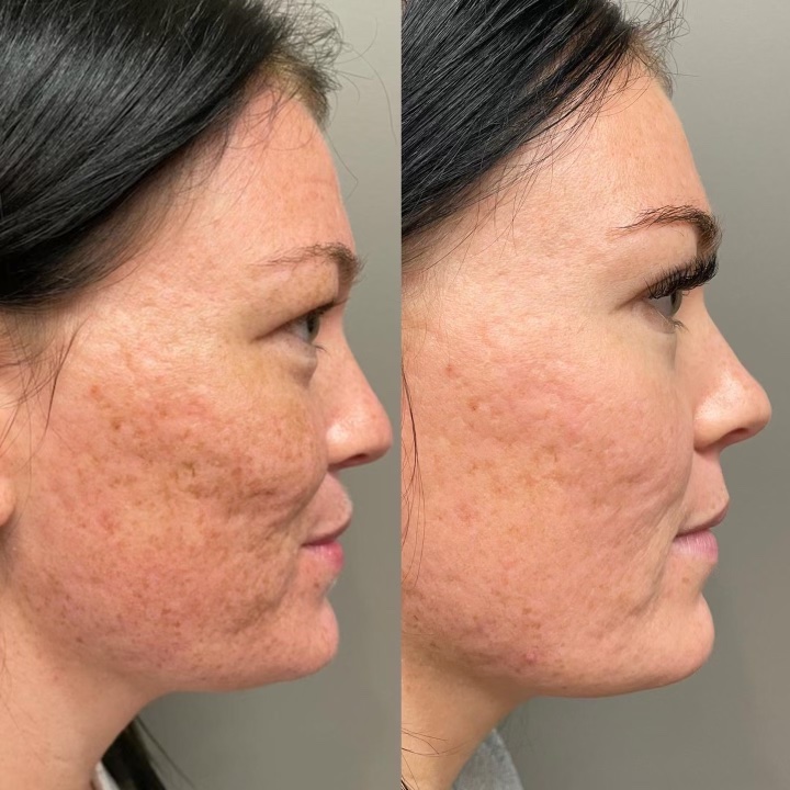 Microneedling Treatment