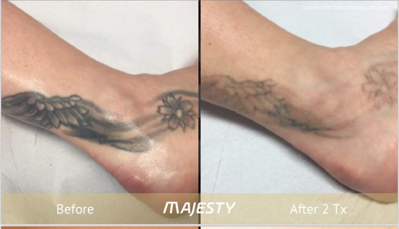 Tattoo removal is a unique journey for each individual and results will  vary. Consultation is an absolute must! Let us help you understand… |  Instagram