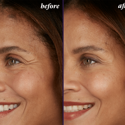 Botox-before-and-after