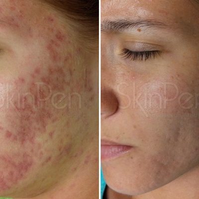 Microneedling Services Before and After Innovative Aesthetics Medical Spa and Laser Center