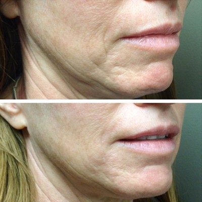 Fillers Before and After Innovative Aesthetics Medical Spa and Laser Center