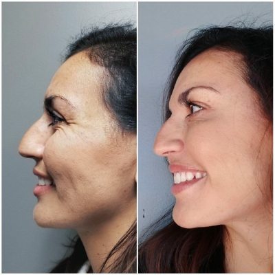 Nose-Botox-Before-After_Innovative-Aesthetics-Spa-Laser-Center-Cedar-Rapids