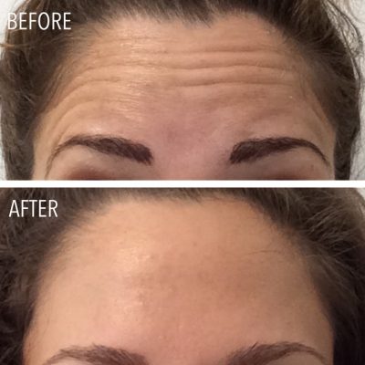 olivia-before-after-forehead-botox-maine-laser-clinic