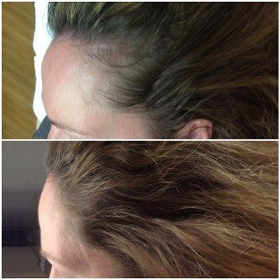 PRP Hair Growth Treatment Before and After Innovative Aesthetics Medical Spa and Laser Center